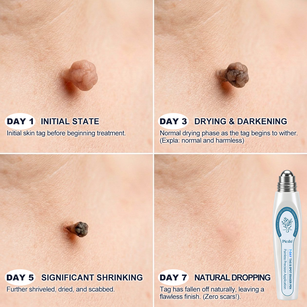 𝐏i𝐜𝐝o® 7-𝐷𝑎𝑦 𝗧𝐚𝐠 & 𝗦𝗽𝐨𝐭 𝐄𝐫𝒂𝒔𝒆𝒓🪄(Zero Pain, Zero 𝐒𝐜𝐚𝒓𝒔 Rollerball)💫