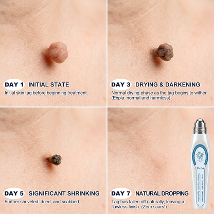𝐏i𝐜𝐝o® 7-𝐷𝑎𝑦 𝗧𝐚𝐠 & 𝗦𝗽𝐨𝐭 𝐄𝐫𝒂𝒔𝒆𝒓🪄(Zero Pain, Zero 𝐒𝐜𝐚𝒓𝒔 Rollerball)💫